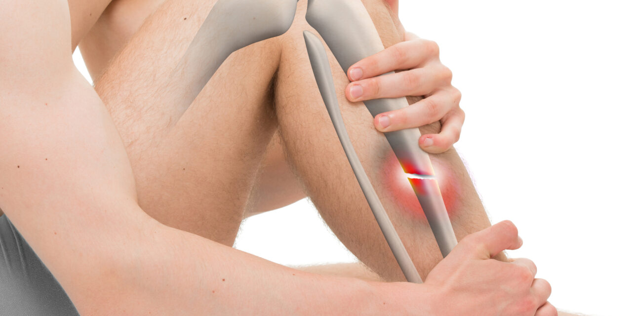 Guide sur les fractures tibia-péroné: Symptômes, soins et orthèses