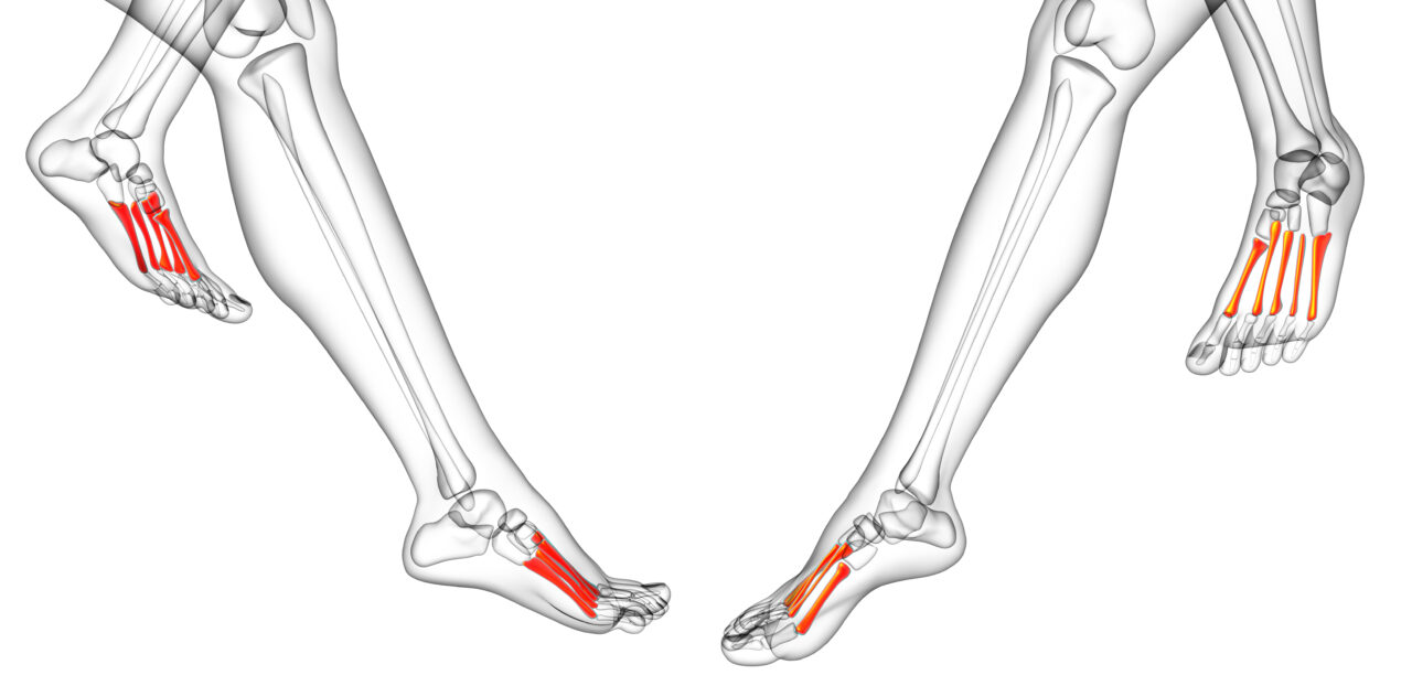 Fractures du métatarse et de fatigue: Guide pratique pour la santé du pied